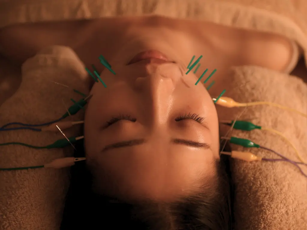 ベーシックリフト美容鍼